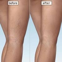 sclerotherapy Oak Brook